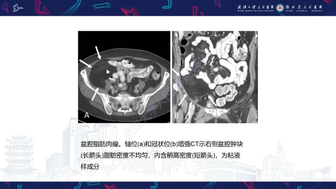 影像PPT - 【PPT】女性盆腔含脂肪病变影像诊断-23