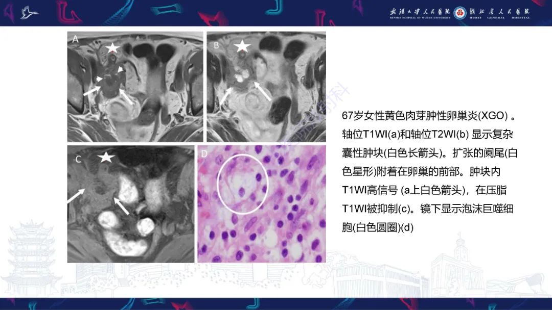 影像PPT - 【PPT】女性盆腔含脂肪病变影像诊断-12