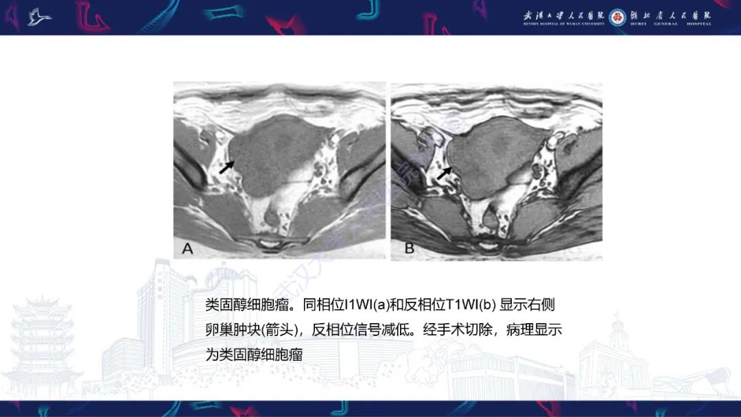 影像PPT - 【PPT】女性盆腔含脂肪病变影像诊断-15