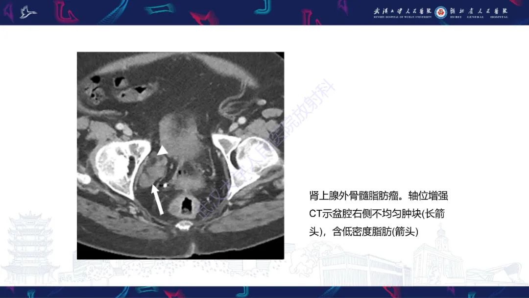 影像PPT - 【PPT】女性盆腔含脂肪病变影像诊断-26