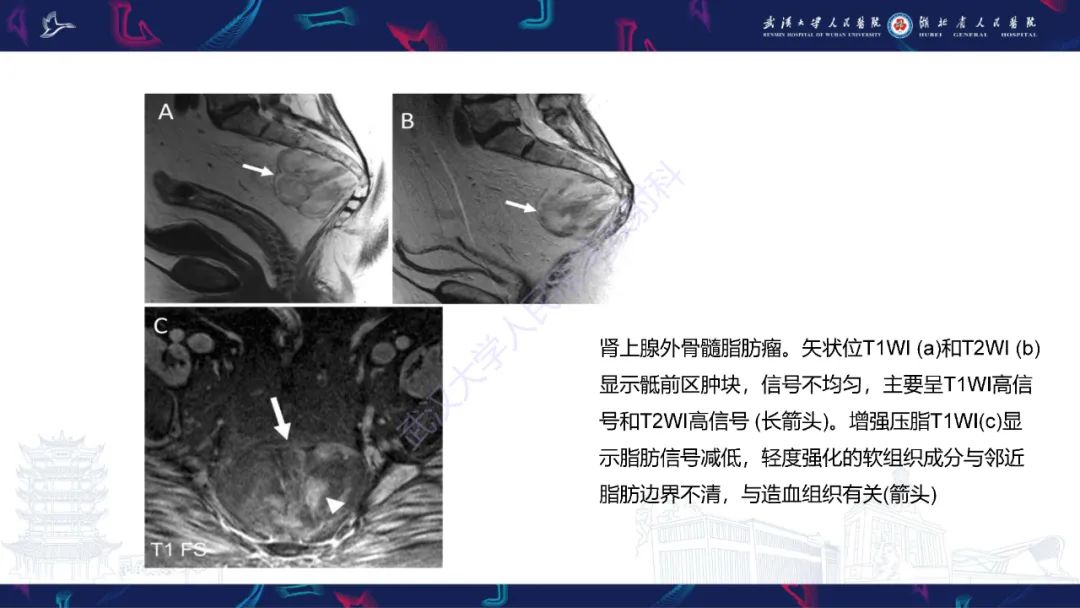 影像PPT - 【PPT】女性盆腔含脂肪病变影像诊断-27