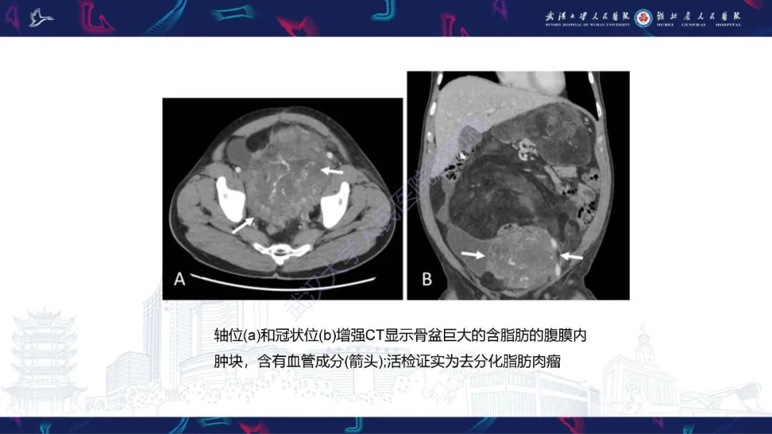 影像PPT - 【PPT】女性盆腔含脂肪病变影像诊断-24