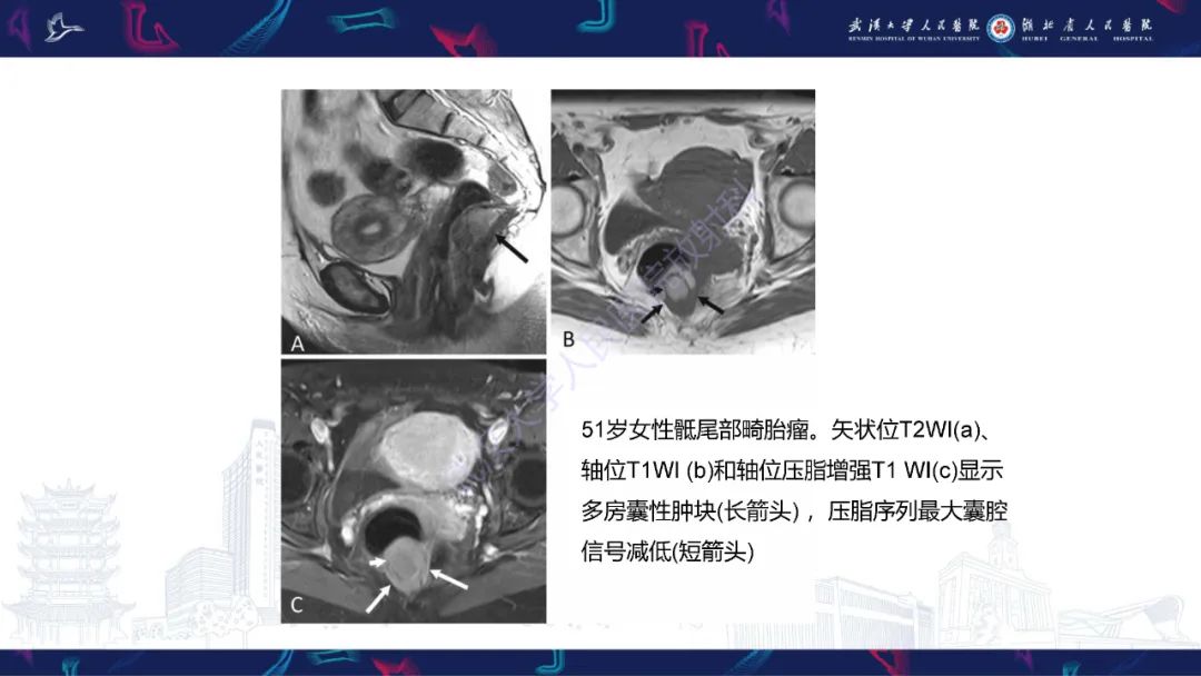 影像PPT - 【PPT】女性盆腔含脂肪病变影像诊断-31