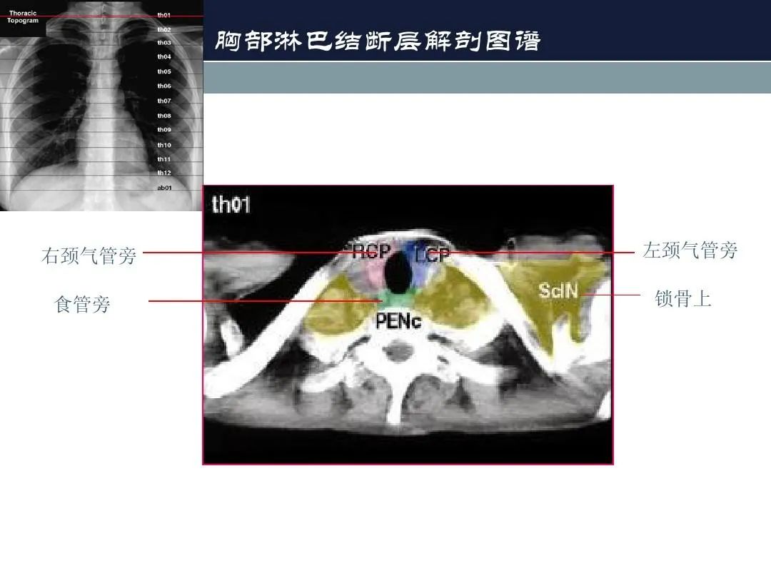 影像PPT - 【PPT】淋巴结引流的断层解剖与影像学分区-13