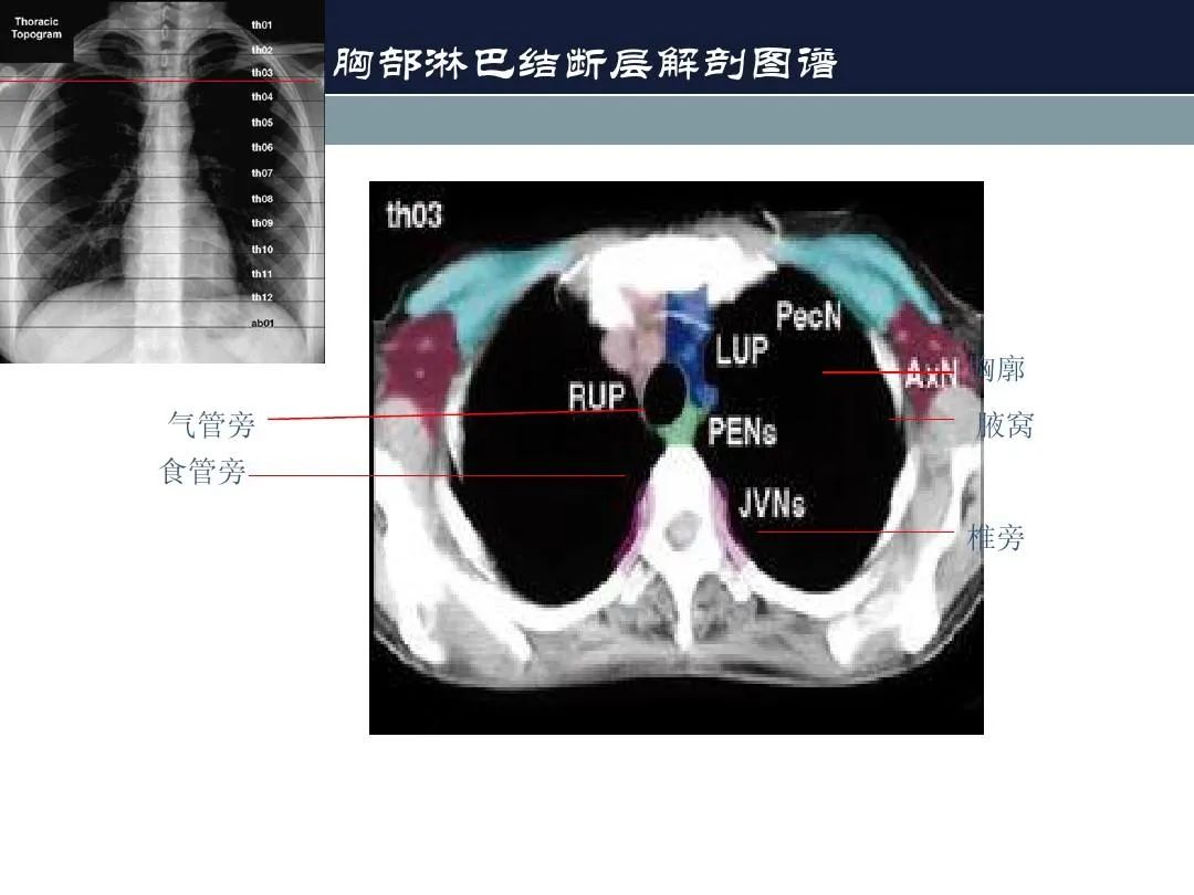 影像PPT - 【PPT】淋巴结引流的断层解剖与影像学分区-15