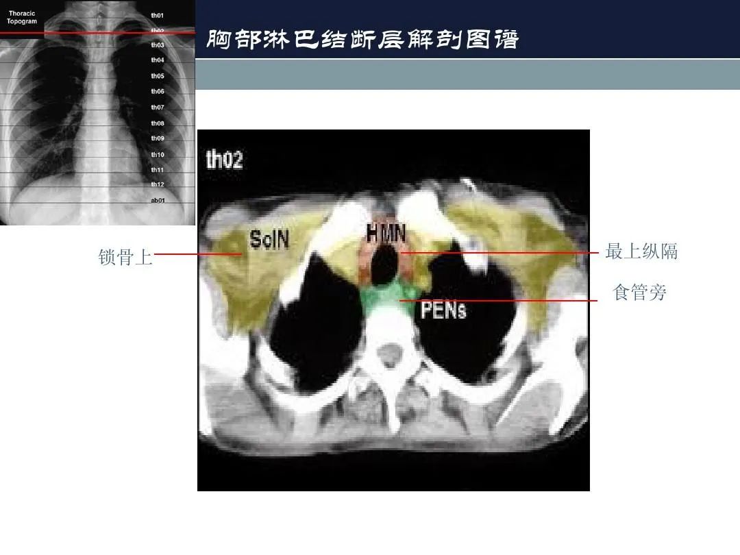 影像PPT - 【PPT】淋巴结引流的断层解剖与影像学分区-14