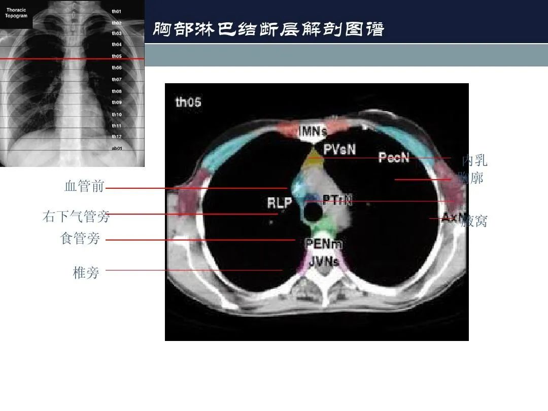 影像PPT - 【PPT】淋巴结引流的断层解剖与影像学分区-17