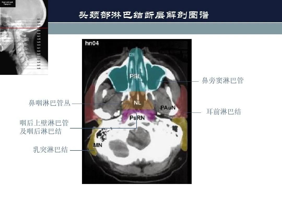 影像PPT - 【PPT】淋巴结引流的断层解剖与影像学分区-3