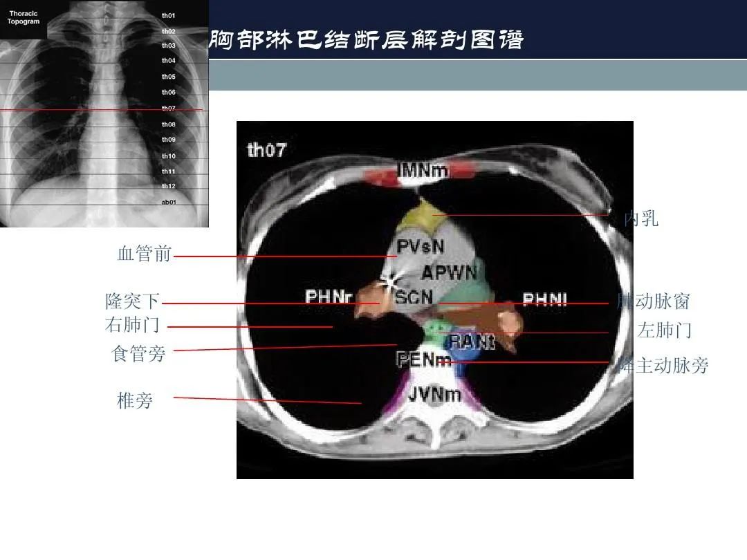 影像PPT - 【PPT】淋巴结引流的断层解剖与影像学分区-19