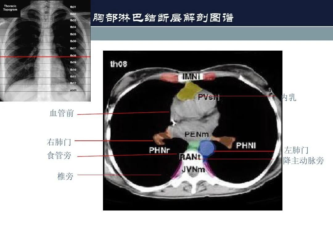影像PPT - 【PPT】淋巴结引流的断层解剖与影像学分区-20