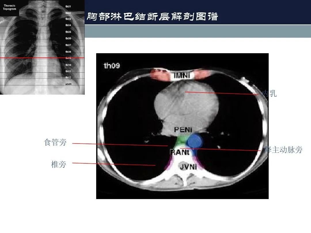影像PPT - 【PPT】淋巴结引流的断层解剖与影像学分区-21