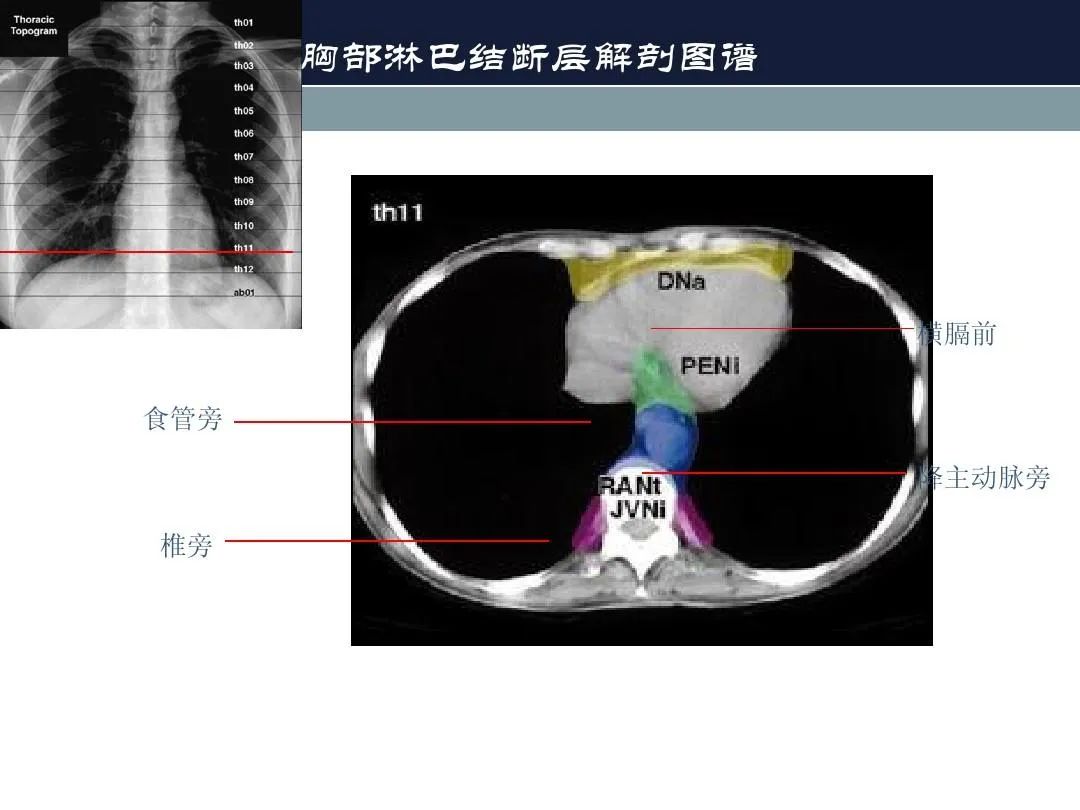 影像PPT - 【PPT】淋巴结引流的断层解剖与影像学分区-23