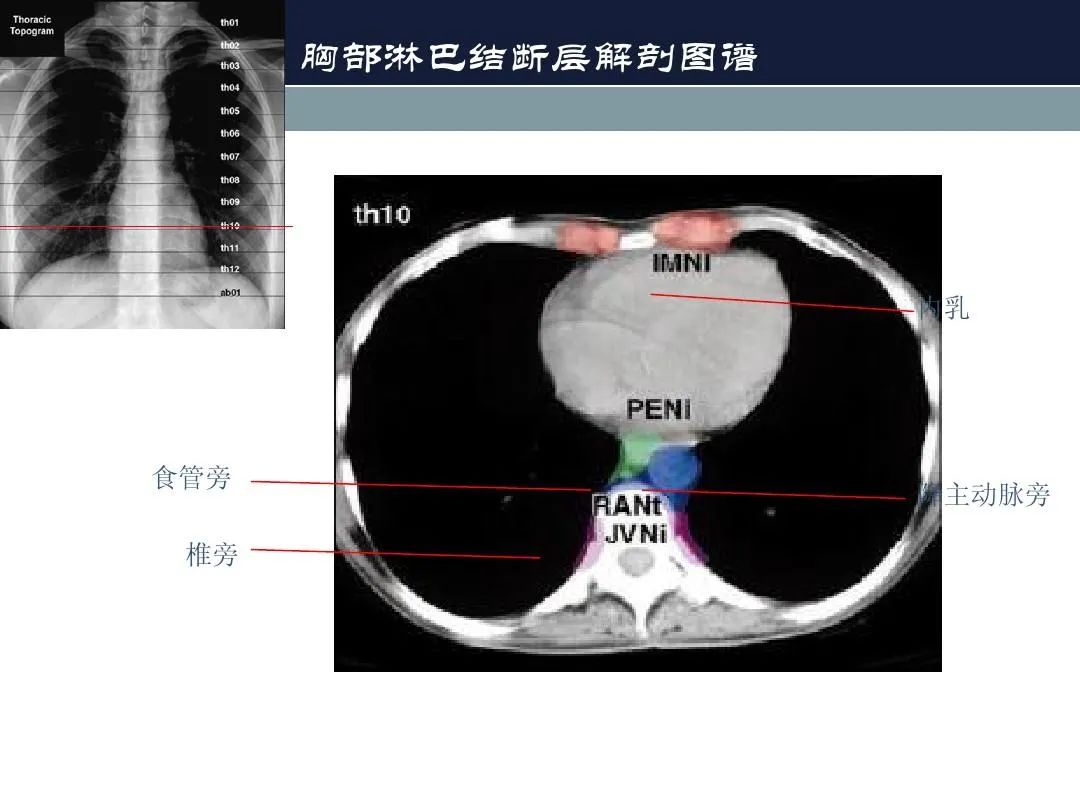 影像PPT - 【PPT】淋巴结引流的断层解剖与影像学分区-22