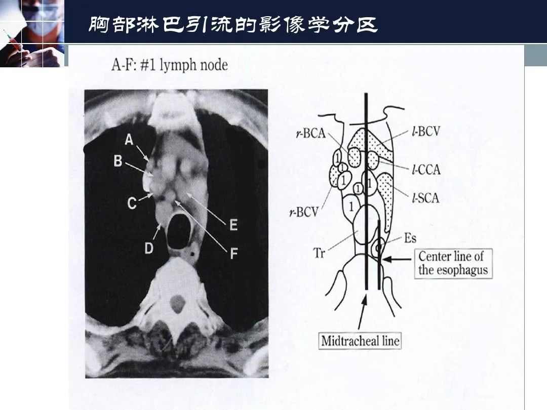 影像PPT - 【PPT】淋巴结引流的断层解剖与影像学分区-28
