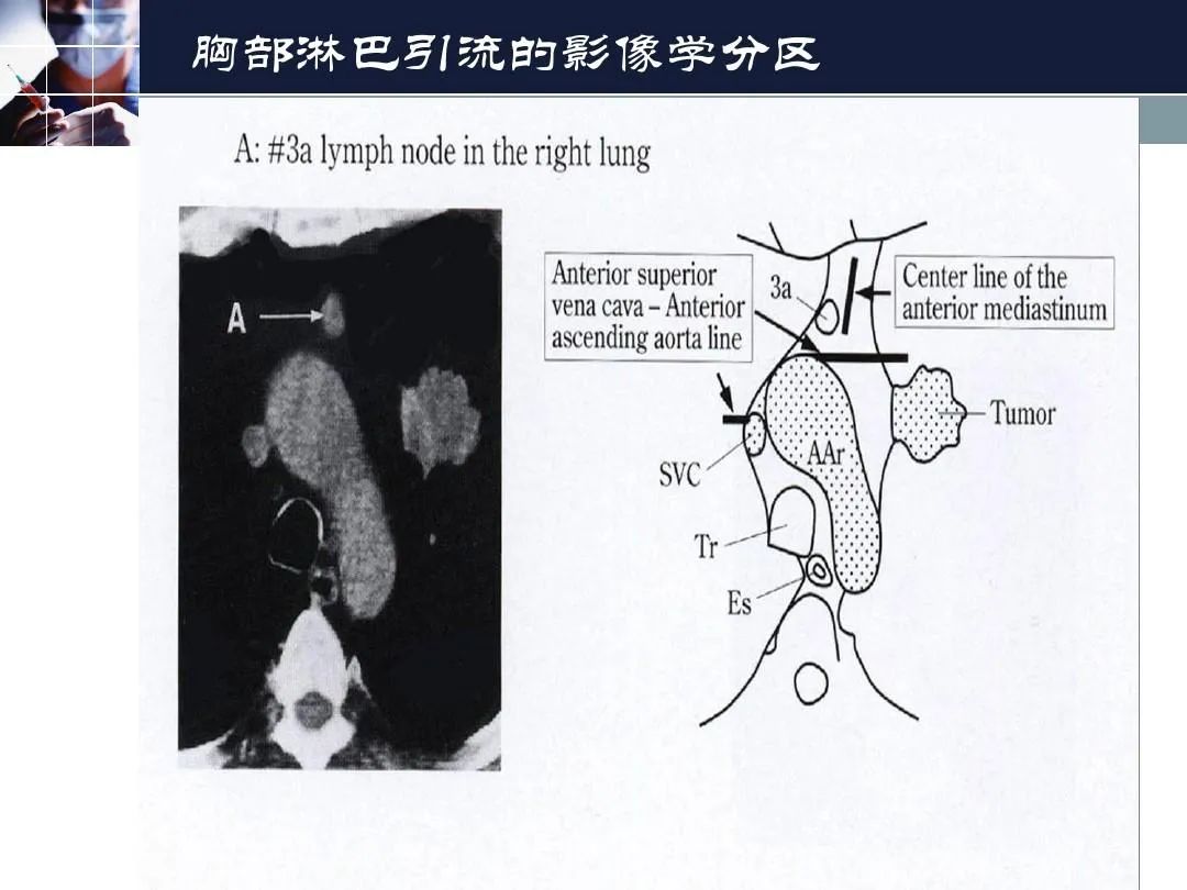 影像PPT - 【PPT】淋巴结引流的断层解剖与影像学分区-29