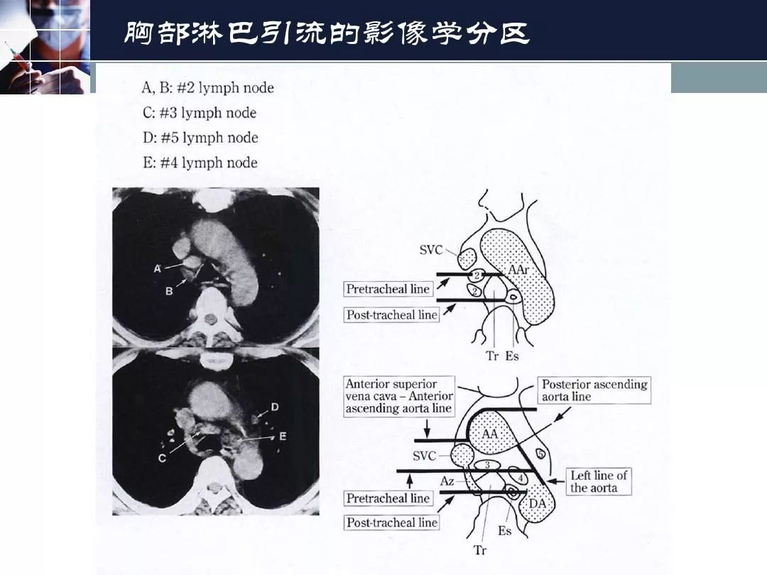 影像PPT - 【PPT】淋巴结引流的断层解剖与影像学分区-30