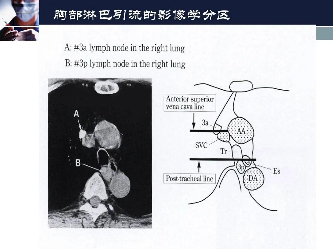 影像PPT - 【PPT】淋巴结引流的断层解剖与影像学分区-31