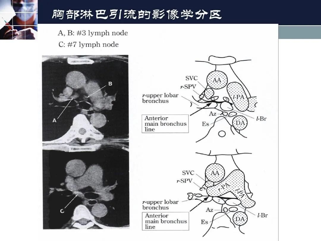 影像PPT - 【PPT】淋巴结引流的断层解剖与影像学分区-34