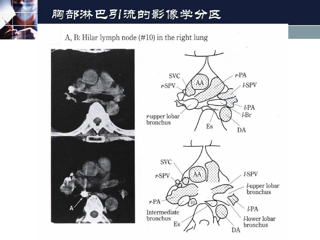 影像PPT - 【PPT】淋巴结引流的断层解剖与影像学分区-35