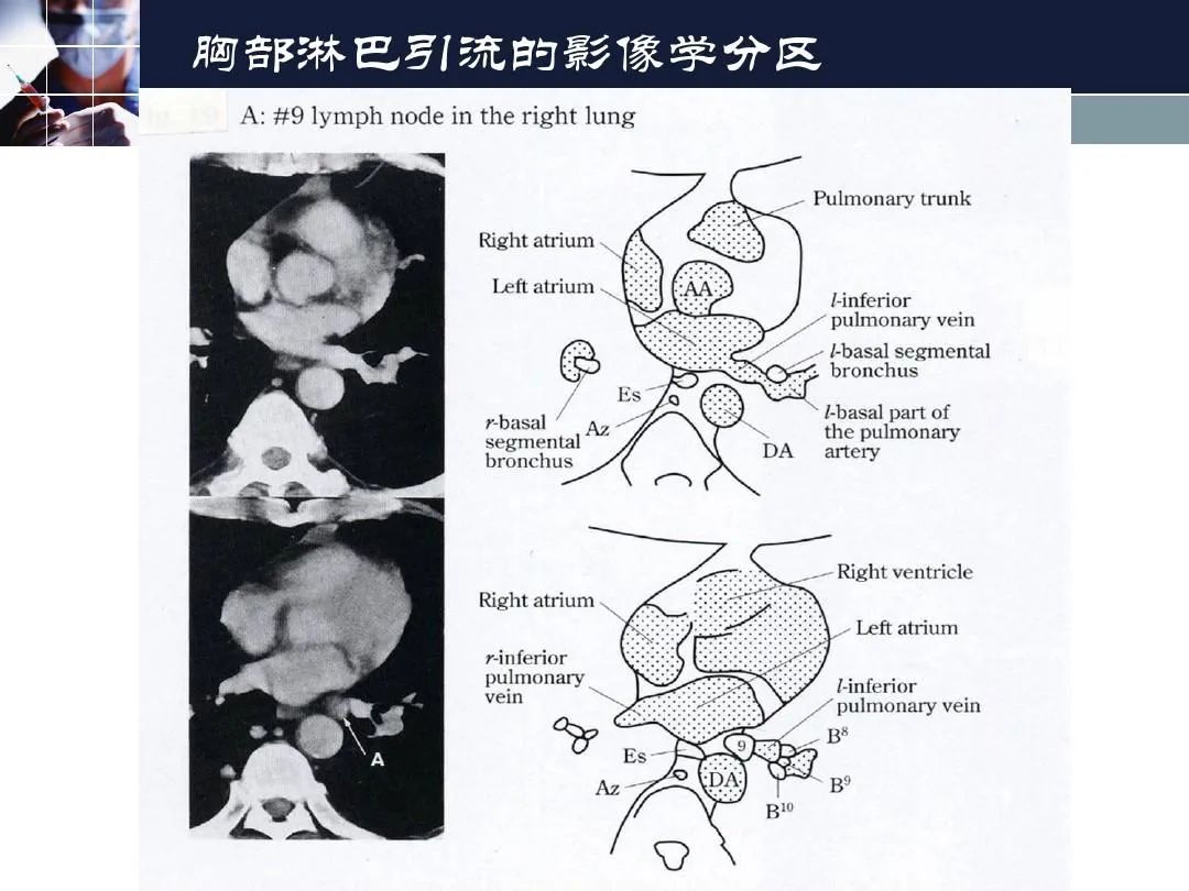 影像PPT - 【PPT】淋巴结引流的断层解剖与影像学分区-37