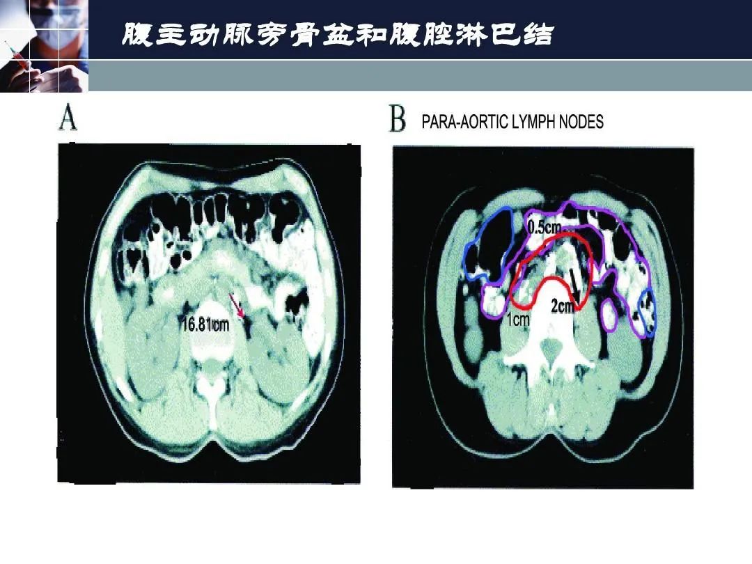 影像PPT - 【PPT】淋巴结引流的断层解剖与影像学分区-39