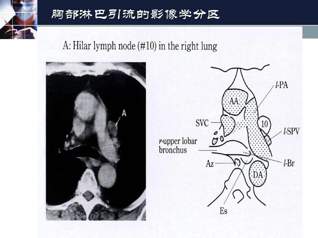 影像PPT - 【PPT】淋巴结引流的断层解剖与影像学分区-38