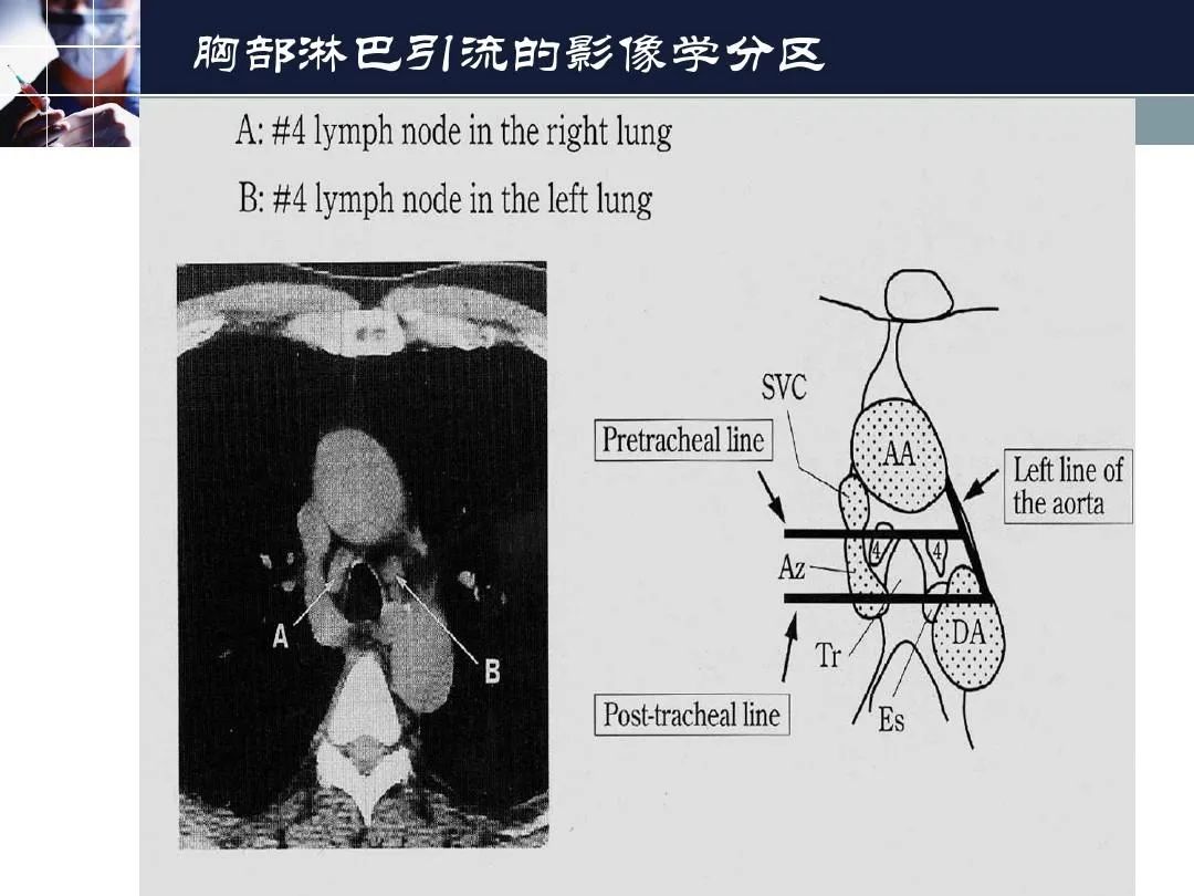 影像PPT - 【PPT】淋巴结引流的断层解剖与影像学分区-32
