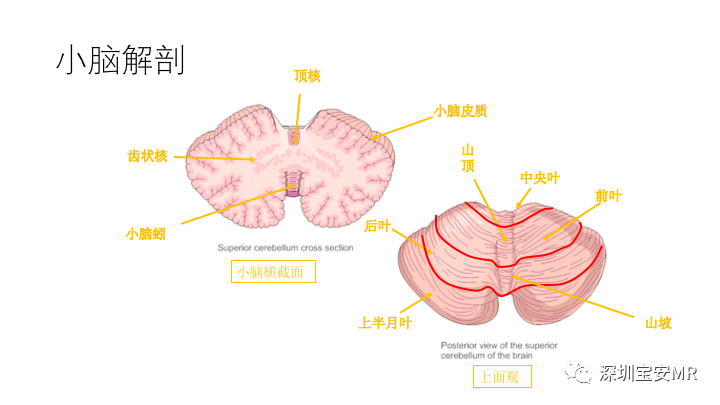 影像PPT - 【PPT】Dandy-Walker综合征-2