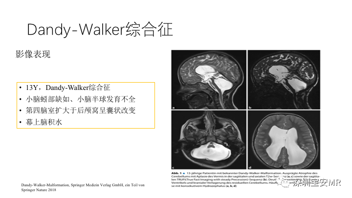 影像PPT - 【PPT】Dandy-Walker综合征-10