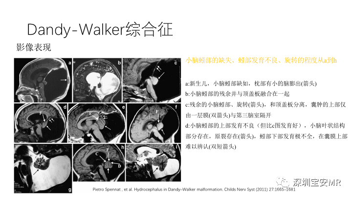 影像PPT - 【PPT】Dandy-Walker综合征-12