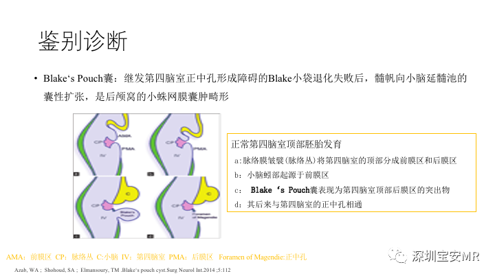 影像PPT - 【PPT】Dandy-Walker综合征-15