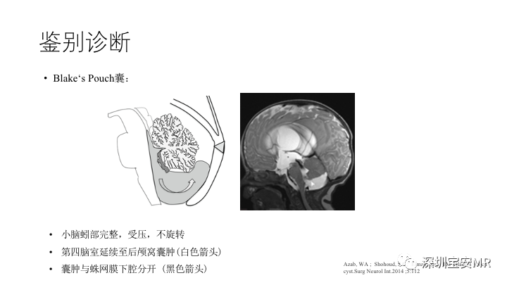 影像PPT - 【PPT】Dandy-Walker综合征-16