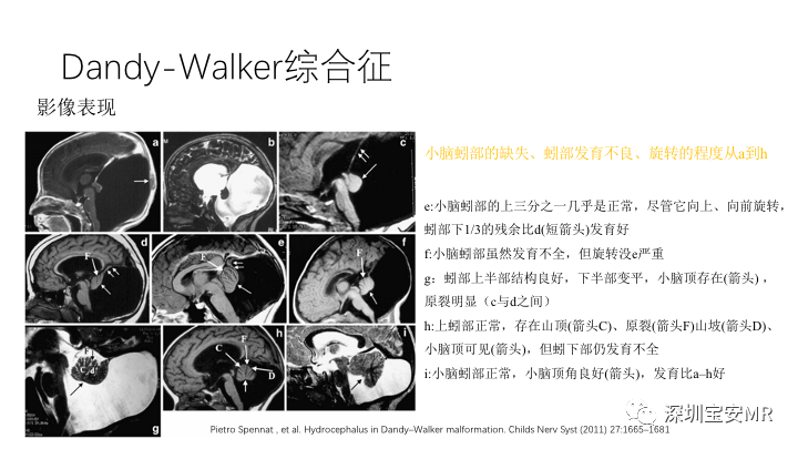 影像PPT - 【PPT】Dandy-Walker综合征-13