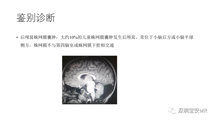 影像PPT - 【PPT】Dandy-Walker综合征-19