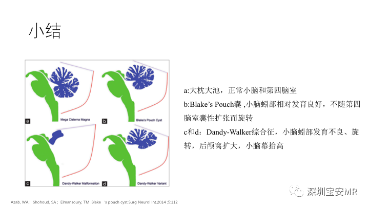 影像PPT - 【PPT】Dandy-Walker综合征-20