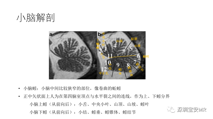 影像PPT - 【PPT】Dandy-Walker综合征-3