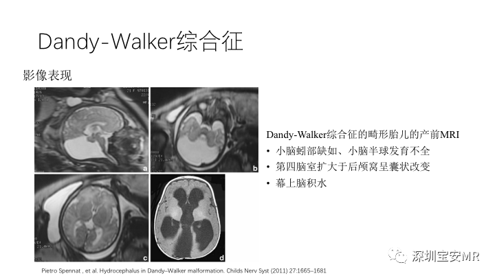 影像PPT - 【PPT】Dandy-Walker综合征-11