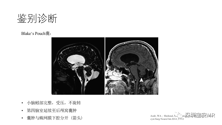 影像PPT - 【PPT】Dandy-Walker综合征-17
