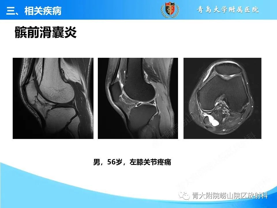 影像PPT - 【PPT】膝关节周围滑囊及其相关疾病的 MRI 表现-13