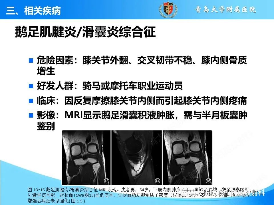 影像PPT - 【PPT】膝关节周围滑囊及其相关疾病的 MRI 表现-14