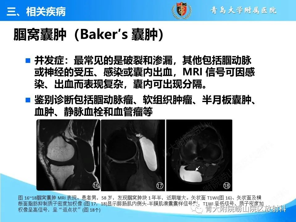 影像PPT - 【PPT】膝关节周围滑囊及其相关疾病的 MRI 表现-19