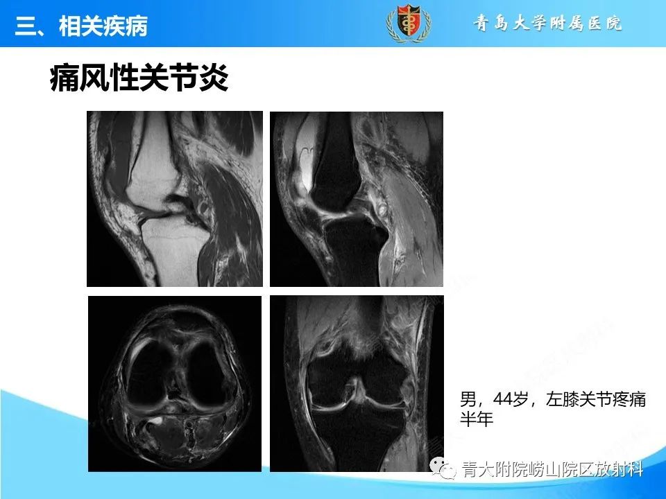 影像PPT - 【PPT】膝关节周围滑囊及其相关疾病的 MRI 表现-25