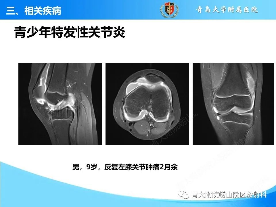 影像PPT - 【PPT】膝关节周围滑囊及其相关疾病的 MRI 表现-29