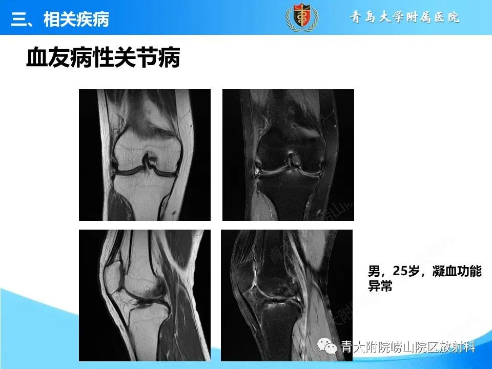 影像PPT - 【PPT】膝关节周围滑囊及其相关疾病的 MRI 表现-31