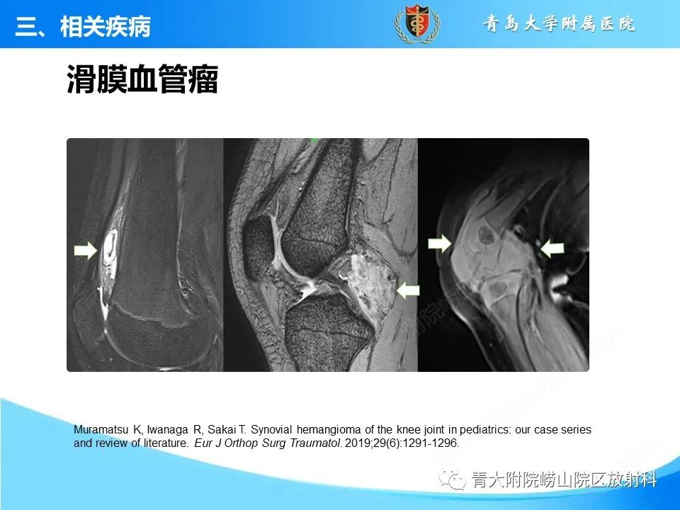 影像PPT - 【PPT】膝关节周围滑囊及其相关疾病的 MRI 表现-34
