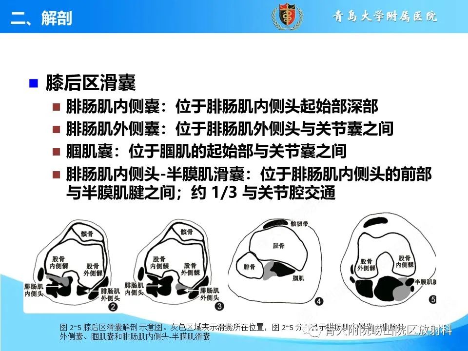 影像PPT - 【PPT】膝关节周围滑囊及其相关疾病的 MRI 表现-8