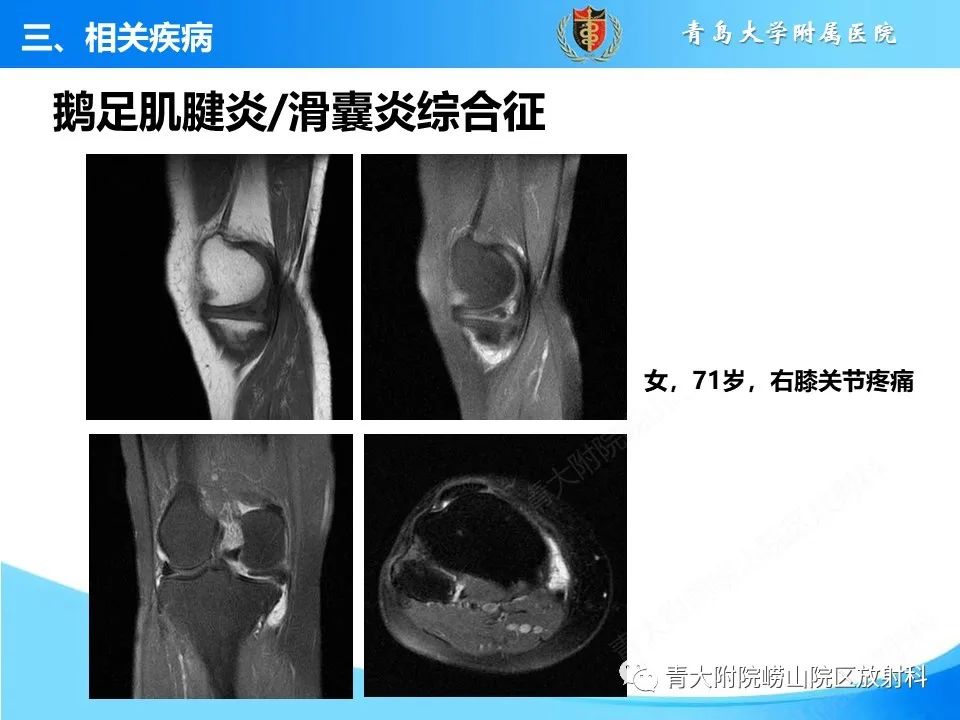影像PPT - 【PPT】膝关节周围滑囊及其相关疾病的 MRI 表现-15