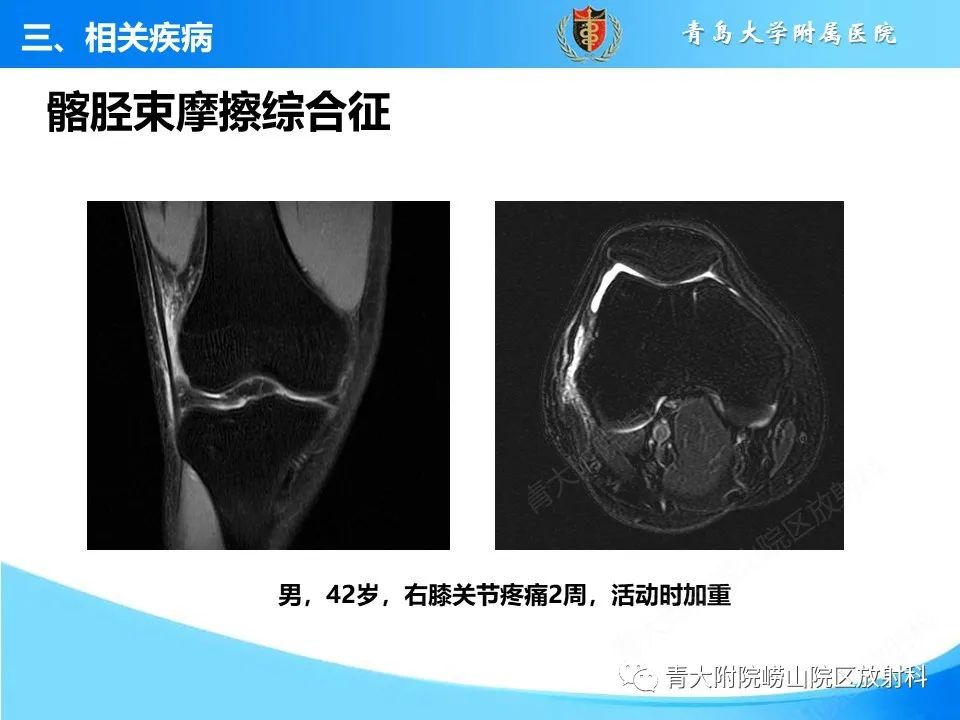 影像PPT - 【PPT】膝关节周围滑囊及其相关疾病的 MRI 表现-17