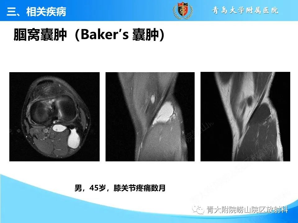 影像PPT - 【PPT】膝关节周围滑囊及其相关疾病的 MRI 表现-20