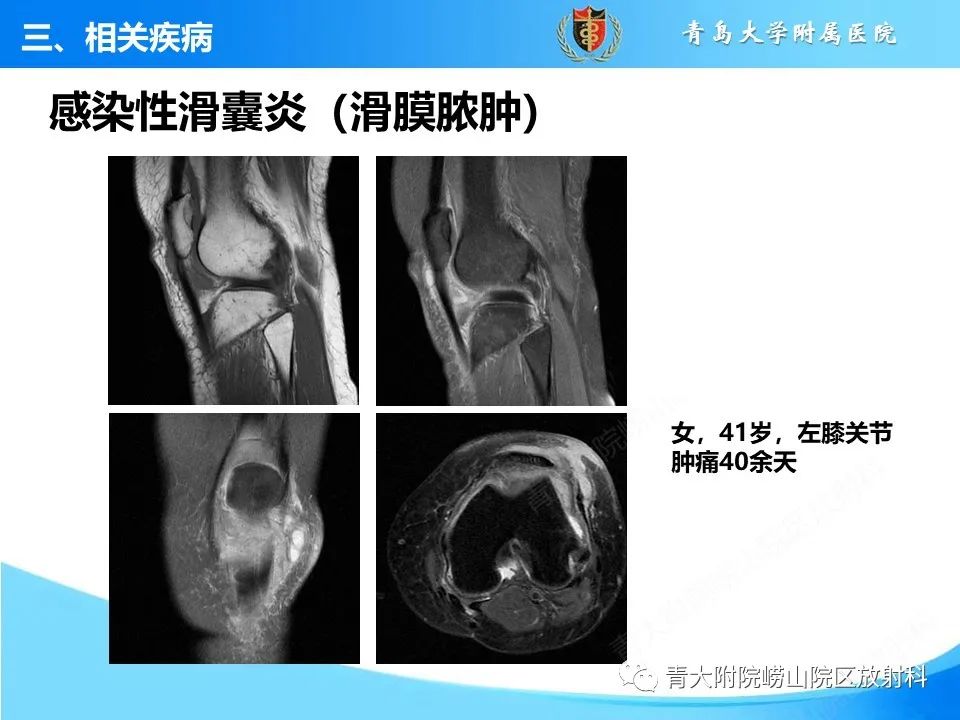 影像PPT - 【PPT】膝关节周围滑囊及其相关疾病的 MRI 表现-22